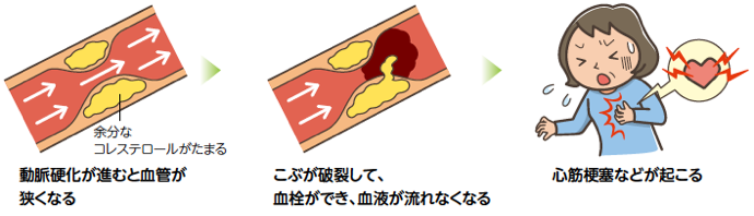 厚生労働省スマートライフプロジェクトHP「動脈硬化を起こし、心筋梗塞や脳梗塞などの原因に」